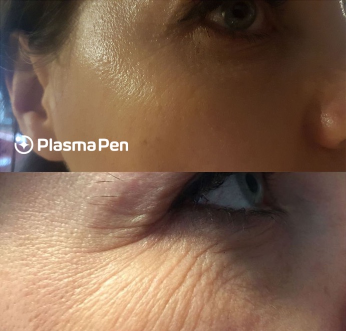 Before & After Plasma Skin Tightening