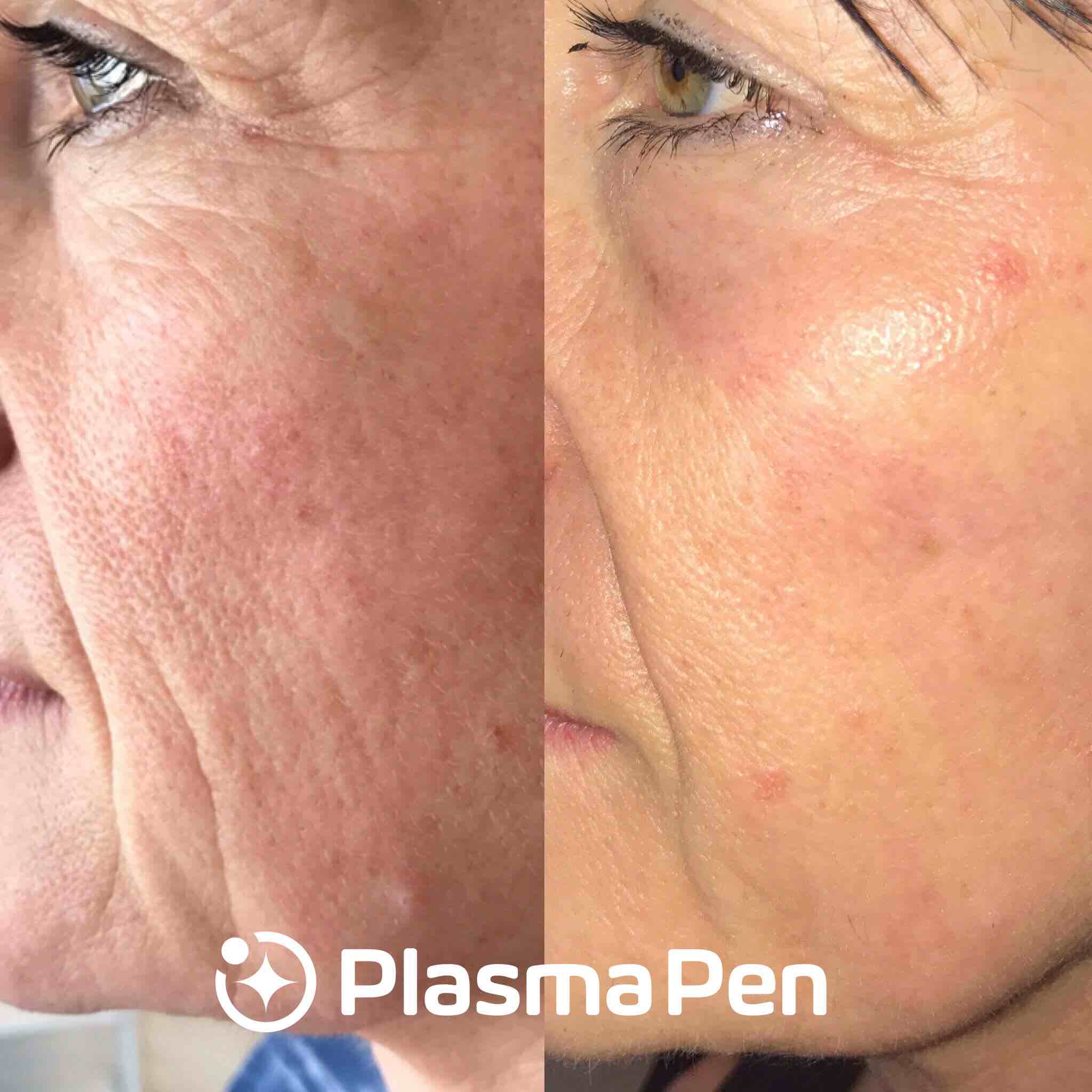 Before & After Plasma Skin Tightening